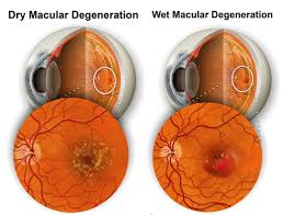 Two main Causes of AMD
