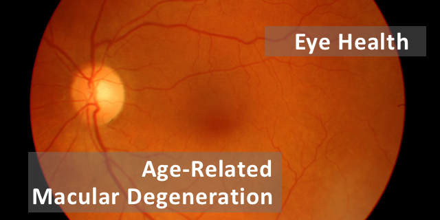 Everything About Age-Related Macular Degeneration